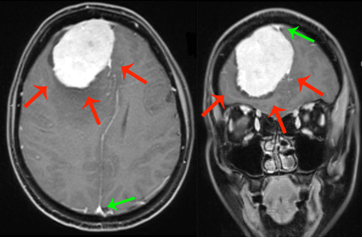 Meningioma Di Convessita Frontale Destra