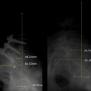 Figura 3: Radiografia pre e postoperatoria mostrano miglioramento dei parametri pelvici