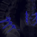 Figura 2: Ricostruzione 3D del sistema di stabilizzazione (blu) mediante tomografia computerizzata.