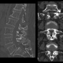 Figura 1: Tomografia computerizzata preoperatoria