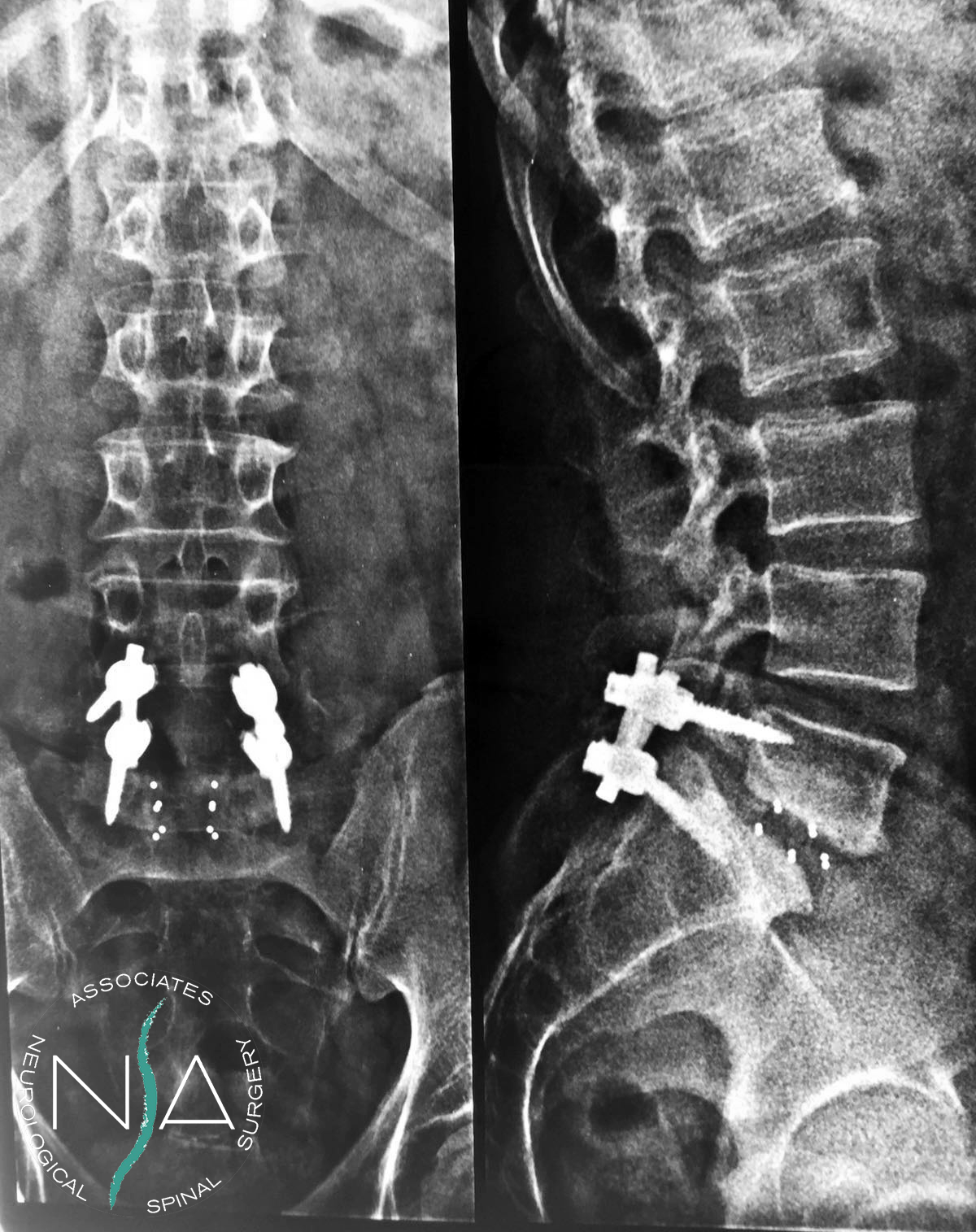 artrodesi l4-l5-s1 e percentuale di invalidità