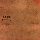 Figura 1: ingrandimento delle ferite chirurgiche a 1 mese dall'intervento